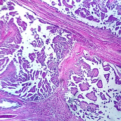 Human Adenocarcinoma of Ovary, sec. 7 µm H&E Microscope Slide