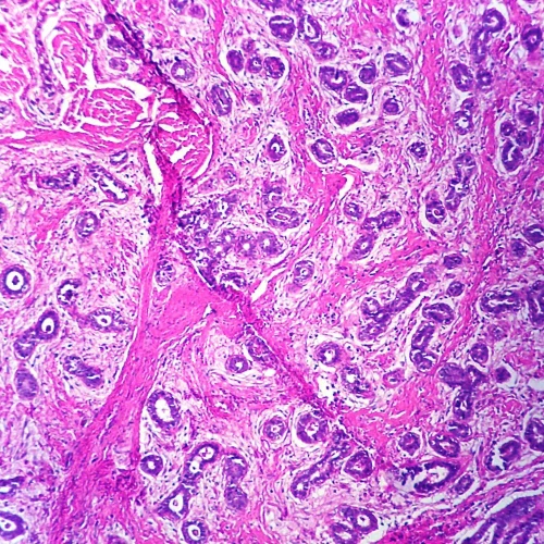 Fibroadenoma, Breast, Microscope Slide