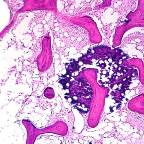Human Osteogenic Sarcoma of Bone, sec. 7 µm, H&E Microscope Slide
