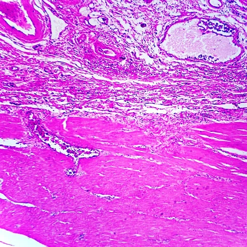 Adenocarcinoma, Stomach, section Microscope Slide