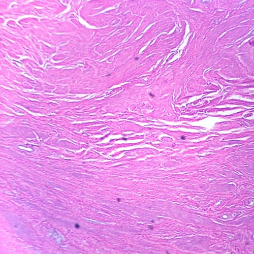 Leiomyoma of Uterus, section Microscope Slide
