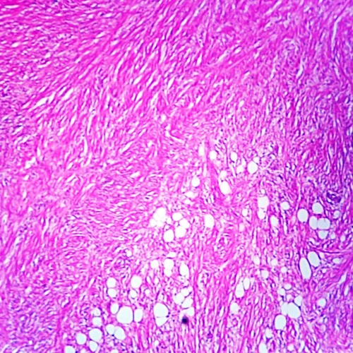 Malignant Schwannoma Nerve, section Microscope Slide