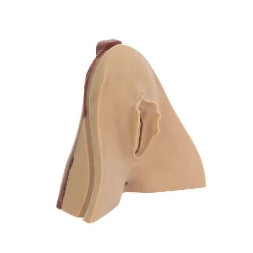 Perineal Repair Replacement Tissue