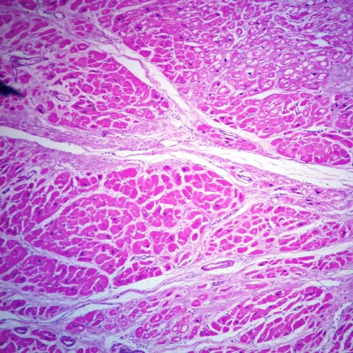Myocardial Infarction, Microscope Slide