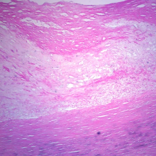 Human Atherosclerosis - Aorta, sec. 7 µm H&E Microscope Slide