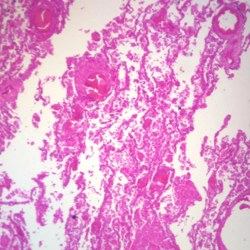 Human Tuberculosis, sec. 7 µm H&E Microscope Slide
