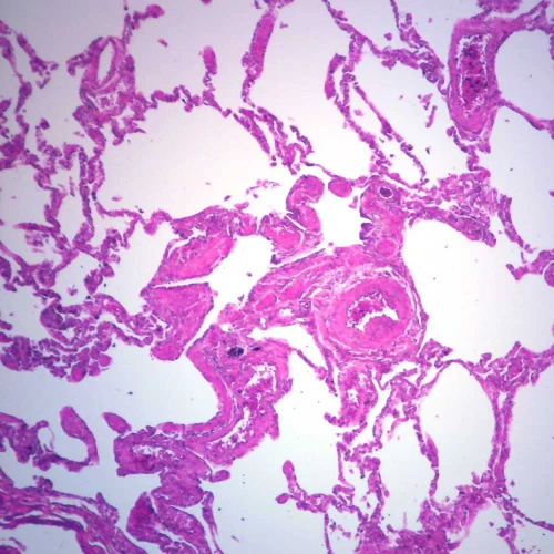 Human Metastatic Melanoma to Lung, 7 µm H&E Microscope Slide
