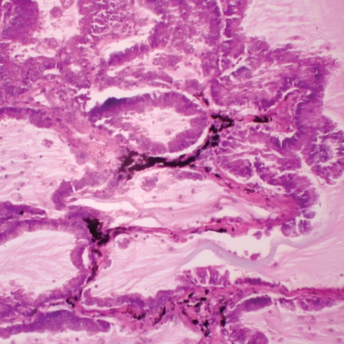 Human Alveolar Cell Carcinoma, sec. 7 µm H&E Microscope Slide