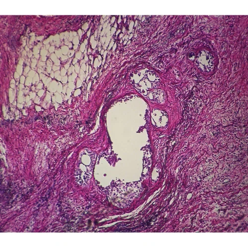 Human Alveolar Cell Carcinoma, sec. 7 µm H&E Microscope Slide