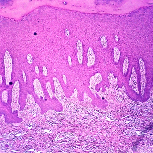 Severe Frostbite, Microscope Slide