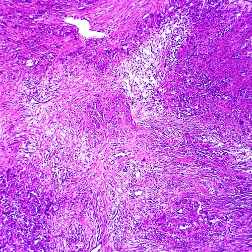 Adenocarcinoma, Colon, section Microscope Slide