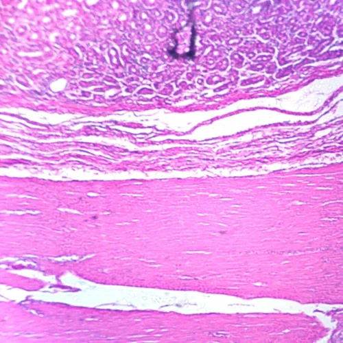 Astrocytoma, section Microscope Slide
