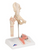 3B Scientific Femoral Fracture and Hip Osteoarthritis, Anatomical Model