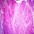 Myocardial Infarction, Sec. Microscope Slide