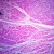 Myocardial Infarction, Microscope Slide