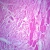 Human Myocardial Infarct, Old, sec. 7 µm, H&E Microscope Slide