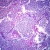 Lobar Pneumonia, Microscope Slide