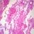 Human Tuberculosis, sec. 7 µm H&E Microscope Slide
