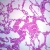 Human Metastatic Melanoma to Lung, 7 µm H&E Microscope Slide