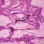 Human Alveolar Cell Carcinoma, sec. 7 µm H&E Microscope Slide