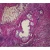 Human Alveolar Cell Carcinoma, sec. 7 µm H&E Microscope Slide