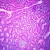 Villous Adenoma Colon, Microscope Slide