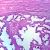 Human Carcinoma of Prostate, sec. 7 µm H&E Microscope Slide