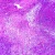 Adenocarcinoma, Colon, section Microscope Slide