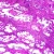 Benign Prostatic Hyperplasia, Microscope Slide