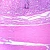 Astrocytoma, section Microscope Slide