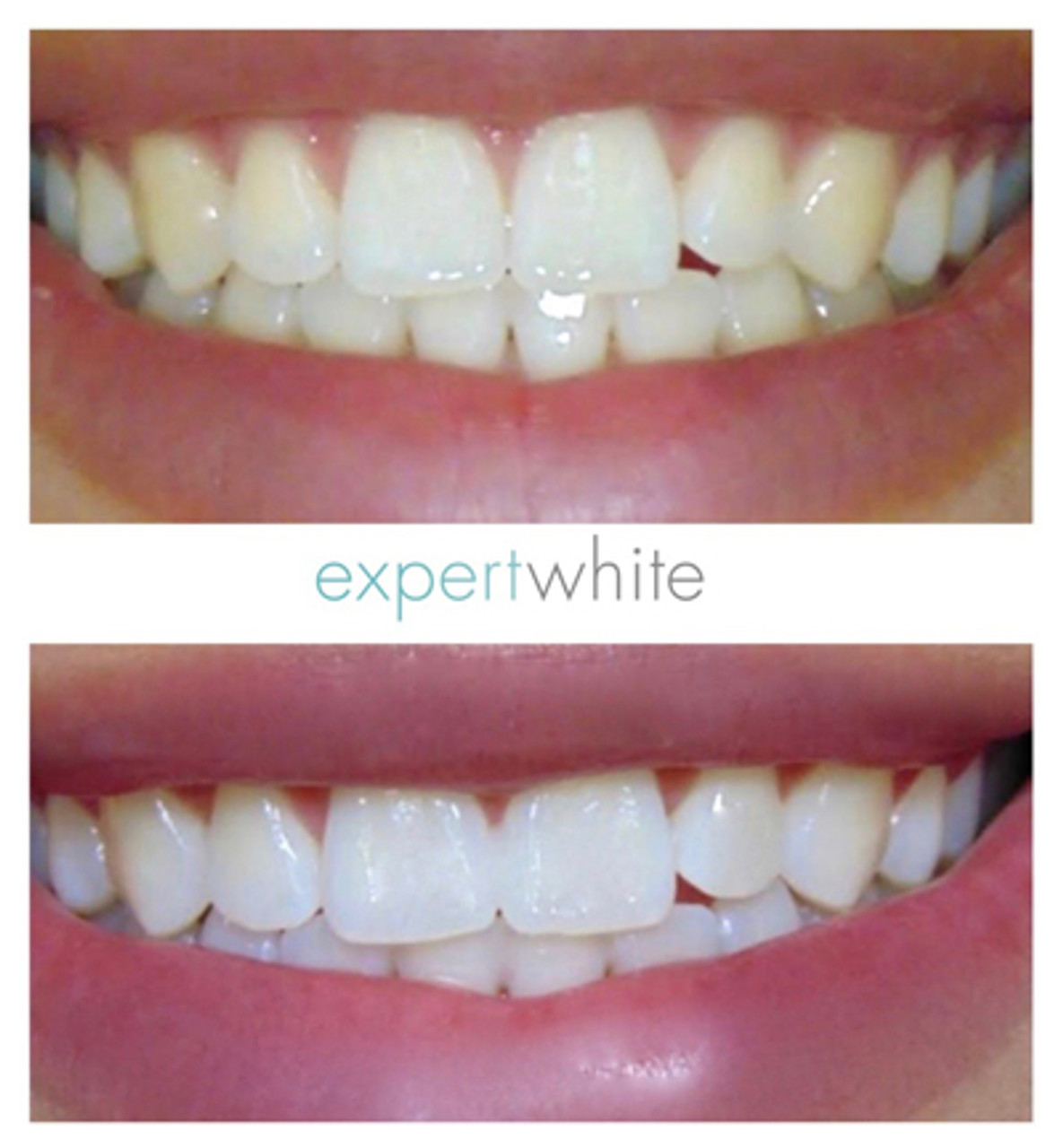 teeth whitening gel and led light