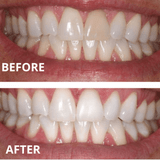 Expertwhite USA 35%CP Prefilled Teeth Whitening Trays 