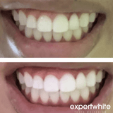 Expertwhite USA 44%CP Prefilled Teeth Whitening Trays 