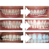 Teeth Whitening Gel 16CP Gentle+ – Sensitive Teeth (20 Gels) | Expertwhite 