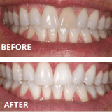 22% Teeth Whitening Gel  – Made in USA  (8 Gels) 