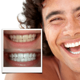 22%CP- Pro Teeth Whitening Gel (8-Gels) SAVE 30% 