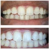 35% Teeth Whitening Gel Made in USA (8 Gels) 