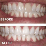 44% Teeth Whitening Gel (20-Gels)  