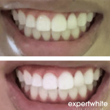 Teeth Whitening Gel -44% CP USA Gel  - Extreme (20-Gels)  | Expertwhite 