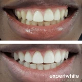 44% Teeth Whitening Gel USA Gel – 15-minutes  (8 Gels) | Expertwhite 