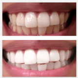 Expertwhite USA Teeth Whitening Strips – 12% Hydrogen Peroxide, Dentist-Grade (28 Strips, 14 Treatments)