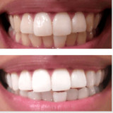 Expertwhite Advanced LED Peroxide Teeth Whitening Kit (Formulated USA)