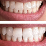 Expertwhite Advanced LED Peroxide Teeth Whitening Kit (Formulated USA)