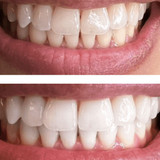 Expertwhite American Grade LEDTeeth Whitening Kit