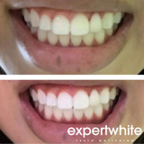  Expertwhite LED Teeth Whitening  Kit (Formulated USA)