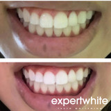 Expertwhite WhiteBomb Trays One Session. Seriously White.