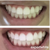 Teeth Whitening Gel 16 Carbamide Peroxide - Sensitive Teeth | Expertwhite 