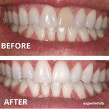 Teeth Whitening Gel 16 Carbamide Peroxide - Sensitive Teeth | Expertwhite 