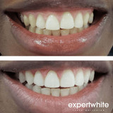 Teeth Whitening Gel 16 Carbamide Peroxide - Sensitive Teeth | Expertwhite 