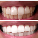 Teeth Whitening Gel 44 Carbamide Peroxide USA – 15-Minute Rapid  | Expertwhite
